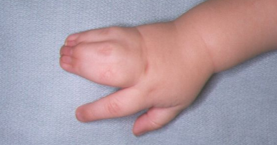 Sindaktili pada Bayi: Gejala, Penyebab, dan Pengobatannya